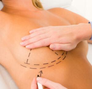 Breast Lift With Augmentation - Donaldson Plastic Surgery